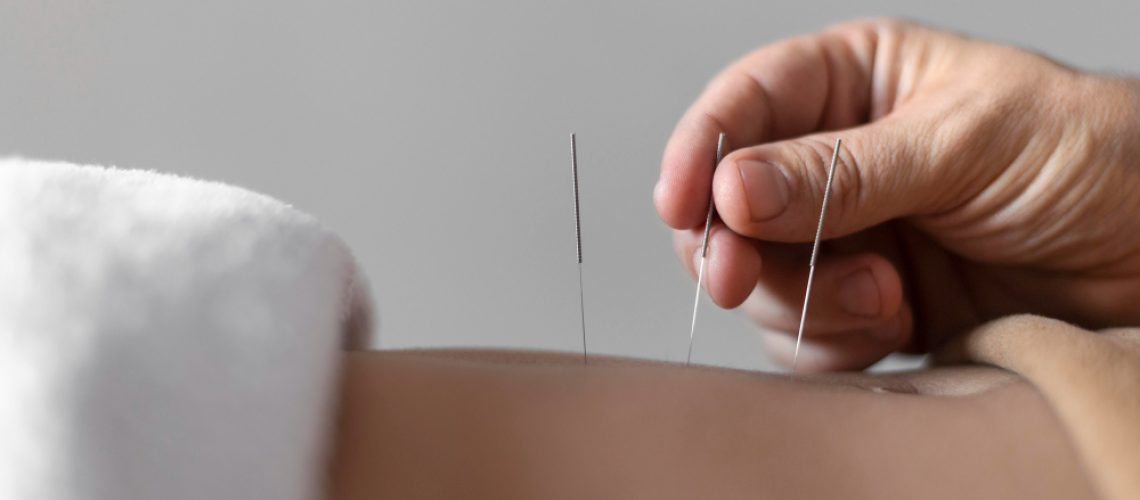 acupuncture-needle
